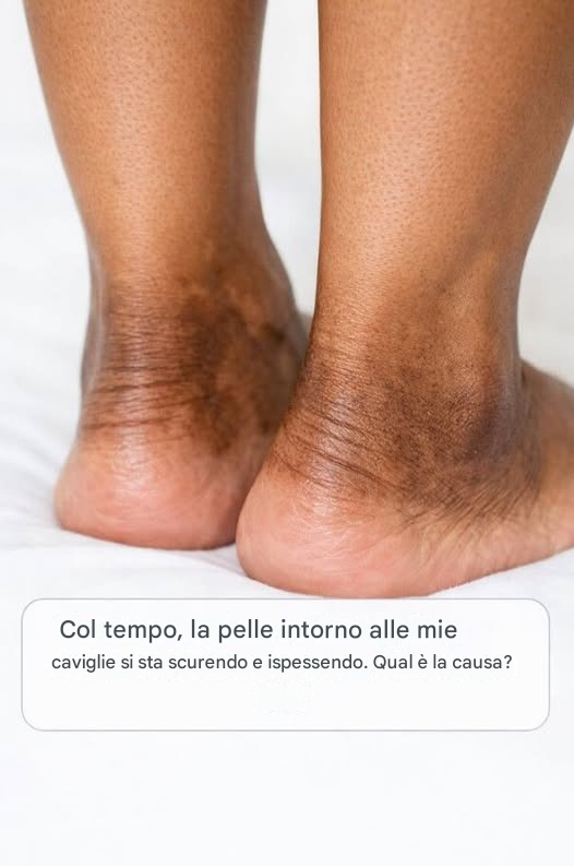 Col tempo, la pelle intorno alle mie caviglie si sta scurendo e ispessendo. Qual è la causa?