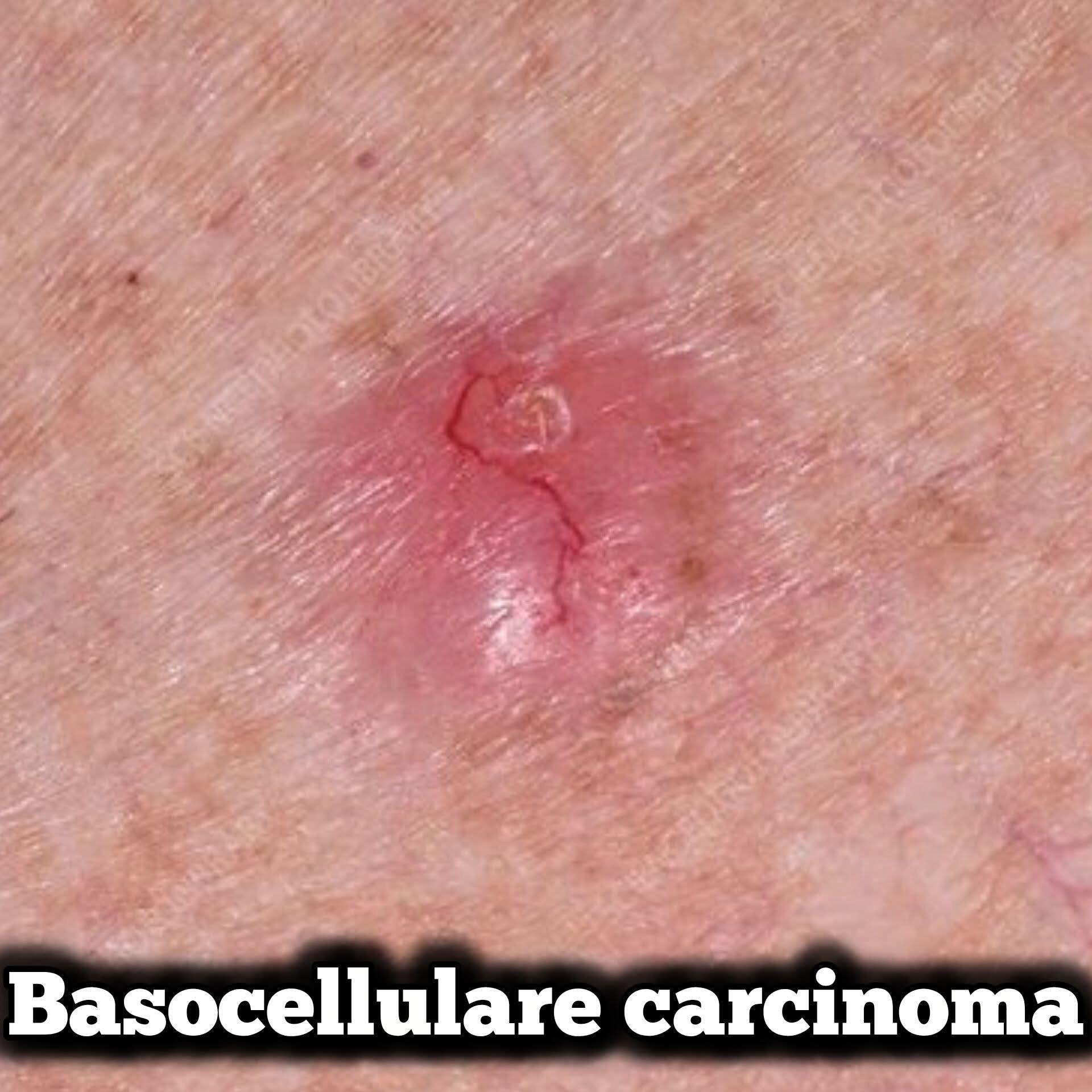 Basocellulare carcinoma, ecco i sintomi a cui prestare attenzione (1 / 2)