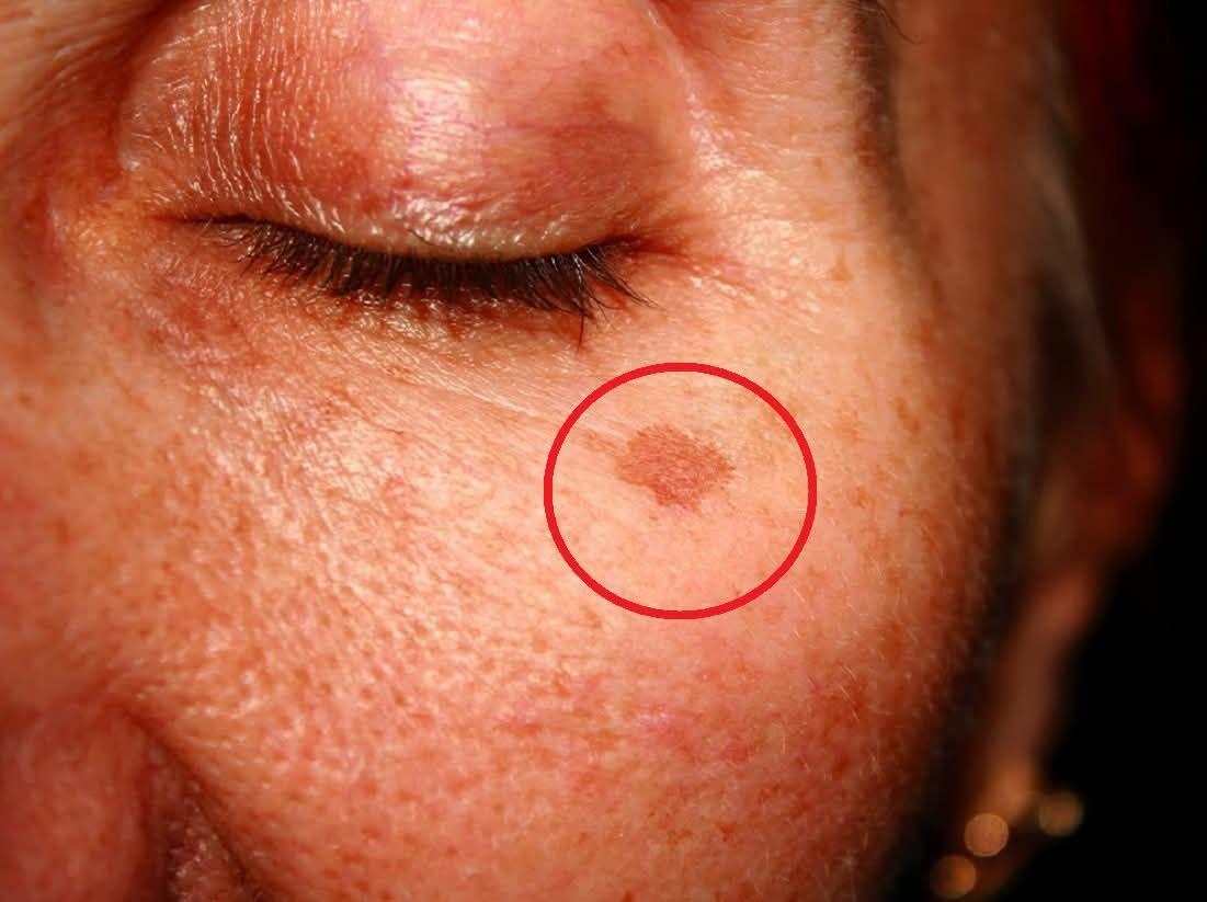 Cosa significa avere queste macchie sul viso e come eliminarle (1 / 2)