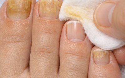 Applica questo semplice trucco sulle unghie e liberati di macchie ostinate, ingiallimento e ruvidità.