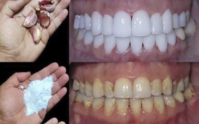 Come sbiancare i denti in 2 minuti?