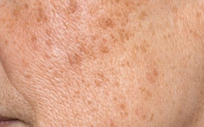 Applica questo semplice trucco sul viso e liberati di macchie solari, discromie e pelle a chiazze.