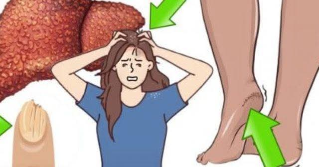 12 sintomi precoci di cirrosi epatica che richiedono particolare attenzione da parte dei medici