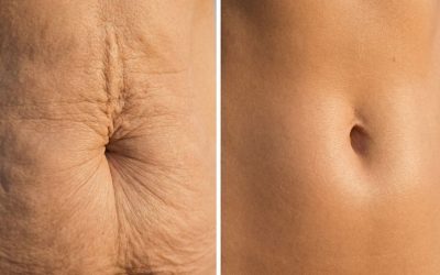 10 modi per rassodare la pelle in modo naturale dopo la perdita di peso.