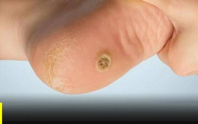 Verruche plantari: cosa sono e perché non vanno confuse con i comuni calli.