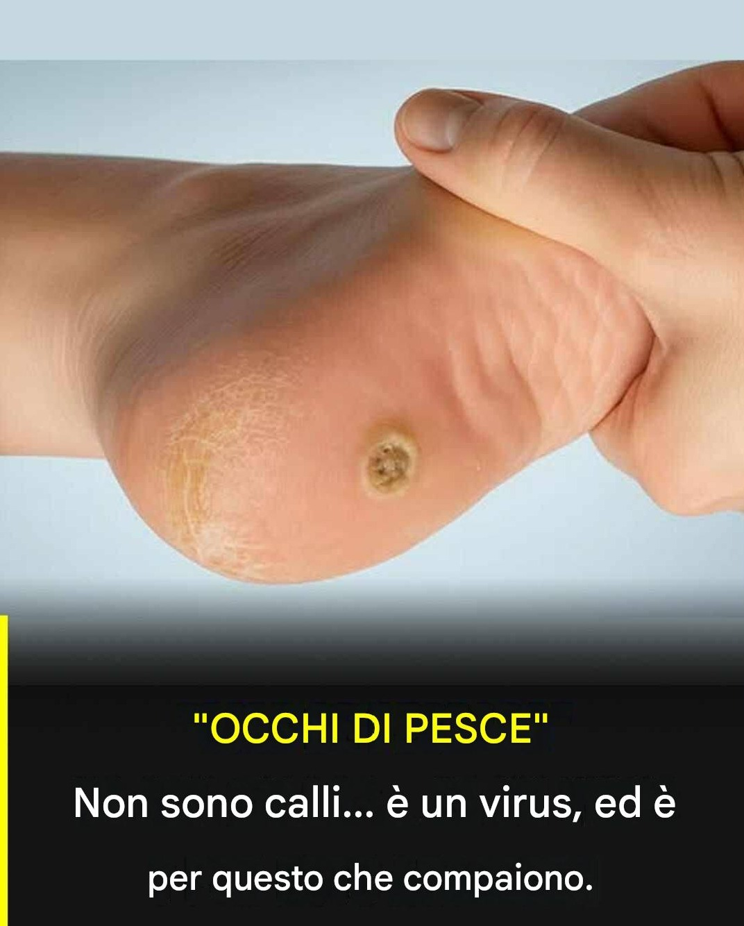 Verruche plantari: cosa sono e perché non vanno confuse con i comuni calli.