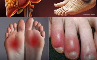 12 sintomi ai piedi che potrebbero indicare un problema al fegato