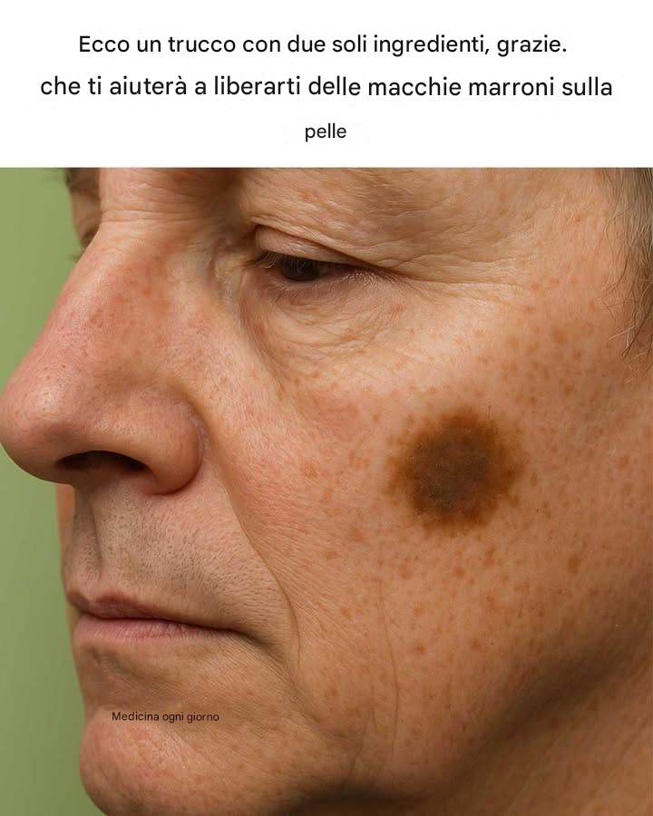 Ecco un trucco con due soli ingredienti per eliminare le macchie marroni sulla pelle.