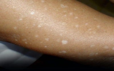 Hai notato delle piccole macchie bianche sulle braccia o sulle gambe? Ecco cosa sono