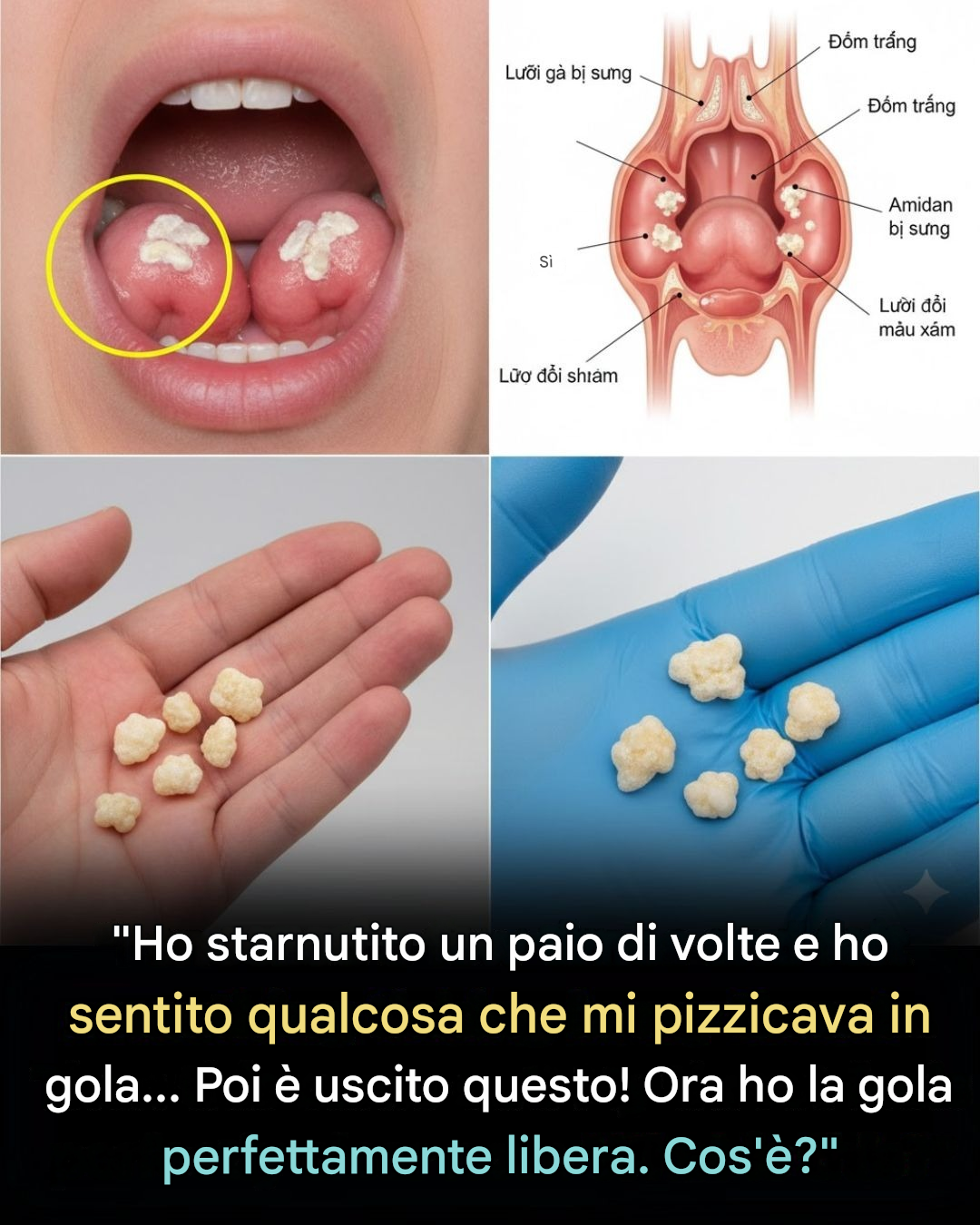 Calcoli tonsillari: capire i piccoli noduli che causano tanto fastidio
