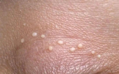 Ho delle piccole protuberanze bianche sulle palpebre e non sono ancora riuscita a farmi visitare da un medico. Cosa potrebbero essere?… CONTINUA A LEGGERE